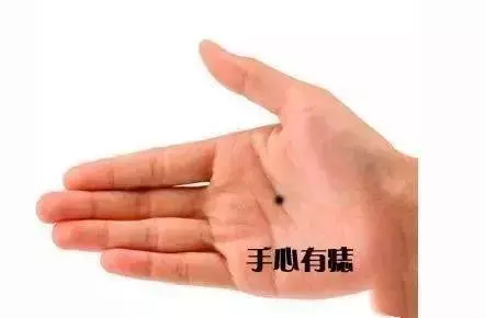 看看你身上這10處有痣嗎?只要有一個,恭喜你了,今生註定發達!