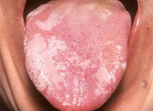 8張教你如何用舌頭顏色變化來分辨出你最近發生了什麼疾病！
