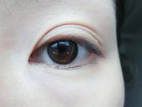 女人有眼袋就打玻尿酸?別傻了,抹點廚房便宜貨,15天撫平眼袋