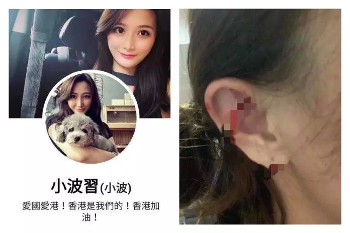 挺港警被打到頭破血流! 電眼正妹爆怒:黑白不分傻了嗎 |