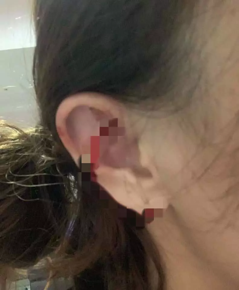挺港警被打到頭破血流! 電眼正妹爆怒:黑白不分傻了嗎 |