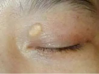高血脂的「禍根」找到了,醫生警示:3種食物再吃,血管會堵塞 !