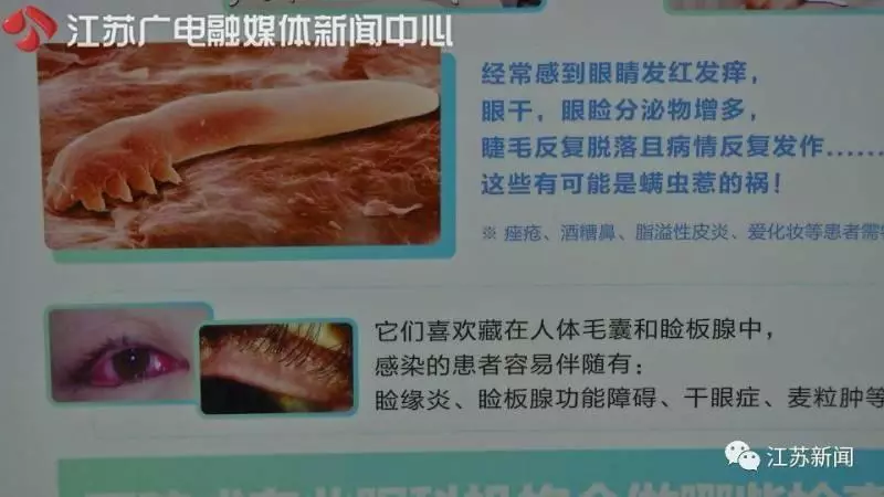 嚇人!女白領眼睛干癢還掉睫毛,竟因這東西在裡面安了家 !
