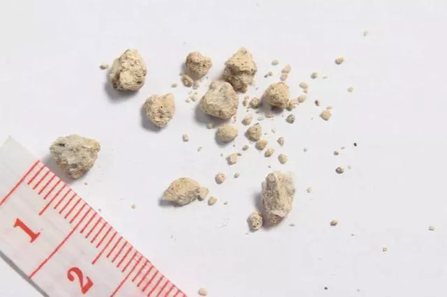 腎結石與水垢有關系嗎?看完才能放心!附:最省錢的預防妙招 !