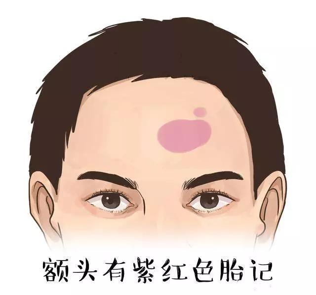 額頭上長了痣、斑、和胎記的人,命運到底好不好 ?