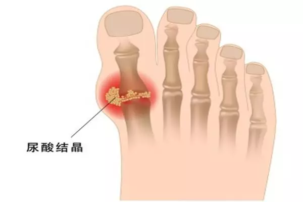 膝蓋抽出2大針管尿酸鹽,竟與長期這樣做有關?專家:須注意這4點