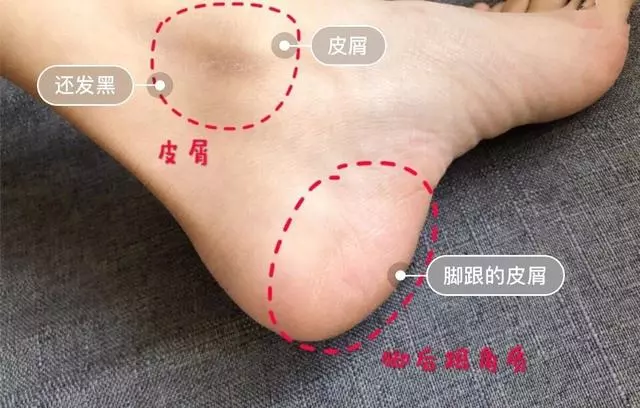 女人的體面要從腳開始:腳糙死皮還乾裂?南非小綠瓶塗一塗准好