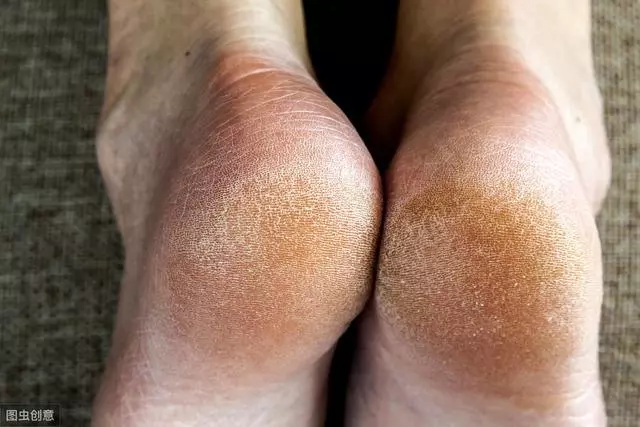 女人的體面要從腳開始:腳糙死皮還乾裂?南非小綠瓶塗一塗准好