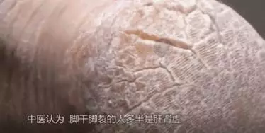 女人的體面要從腳開始:腳糙死皮還乾裂?南非小綠瓶塗一塗准好