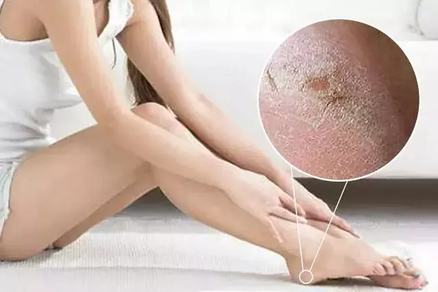 女人的體面要從腳開始:腳糙死皮還乾裂?南非小綠瓶塗一塗准好