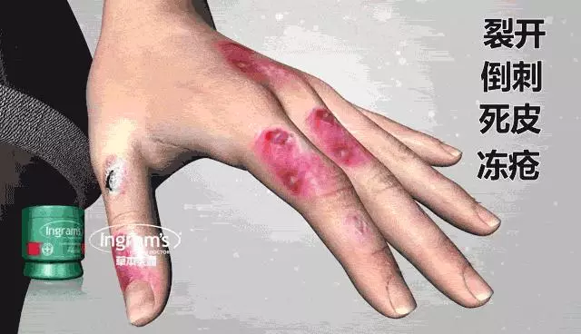 女人的體面要從腳開始:腳糙死皮還乾裂?南非小綠瓶塗一塗准好