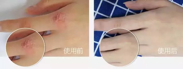 女人的體面要從腳開始:腳糙死皮還乾裂?南非小綠瓶塗一塗准好