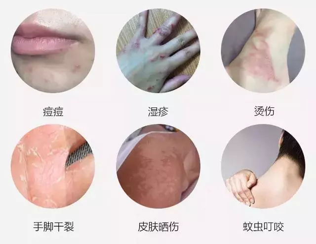 女人的體面要從腳開始:腳糙死皮還乾裂?南非小綠瓶塗一塗准好
