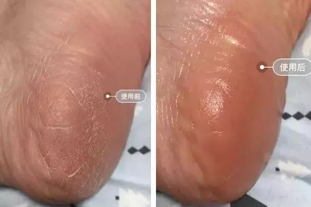 女人的體面要從腳開始:腳糙死皮還乾裂?南非小綠瓶塗一塗准好