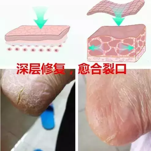 女人的體面要從腳開始:腳糙死皮還乾裂?南非小綠瓶塗一塗准好