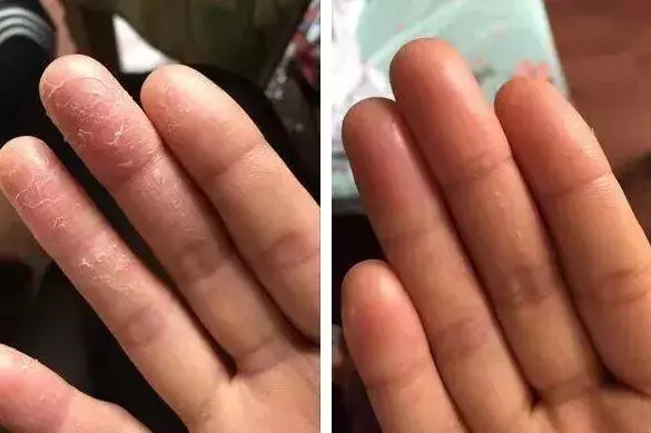 女人的體面要從腳開始:腳糙死皮還乾裂?南非小綠瓶塗一塗准好