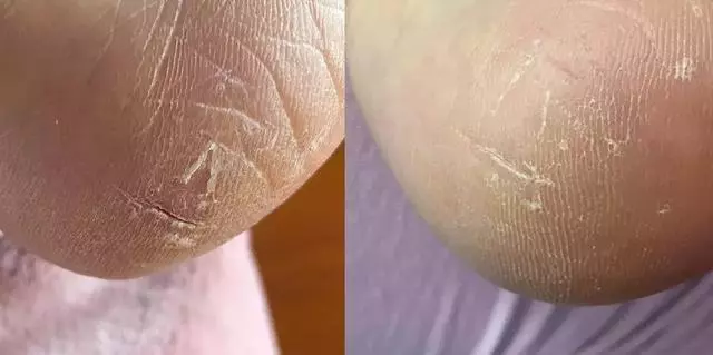 女人的體面要從腳開始:腳糙死皮還乾裂?南非小綠瓶塗一塗准好