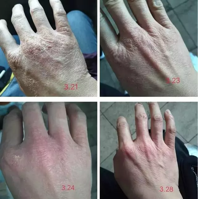 女人的體面要從腳開始:腳糙死皮還乾裂?南非小綠瓶塗一塗准好