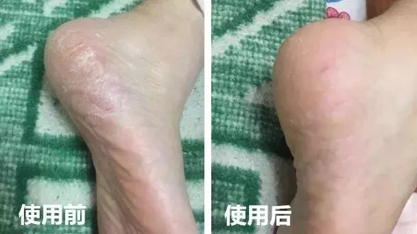 女人的體面要從腳開始:腳糙死皮還乾裂?南非小綠瓶塗一塗准好