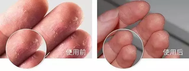 女人的體面要從腳開始:腳糙死皮還乾裂?南非小綠瓶塗一塗准好