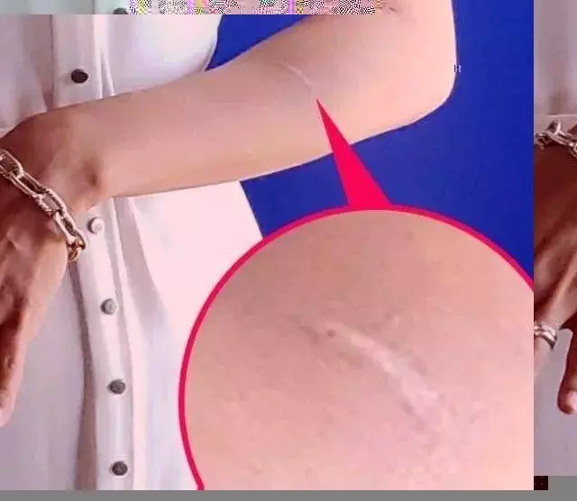 自曝被家暴?35歲鍾嘉欣返港出席活動左手明顯有傷疤:傷口發炎了