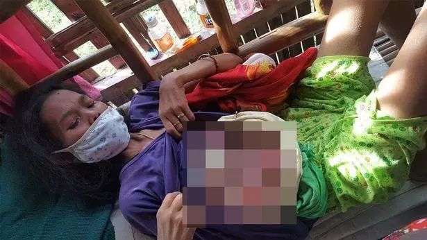菲律賓母親患乳腺癌無錢看病,靠喝草藥自行治療,腫瘤長至人頭大