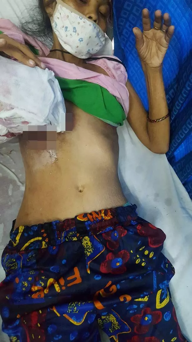 菲律賓母親患乳腺癌無錢看病,靠喝草藥自行治療,腫瘤長至人頭大