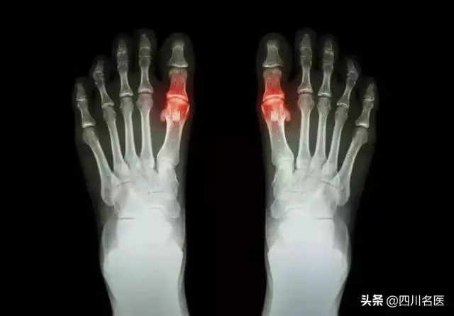 號稱痛中之王,損心損腎還致殘!為啥這病四川高發?醫生:大假降至,管住嘴