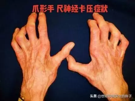 手指麻木疼痛,夜間加重,白天減輕,很可能是這兩種問題惹的禍