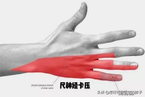 手指麻木疼痛,夜間加重,白天減輕,很可能是這兩種問題惹的禍