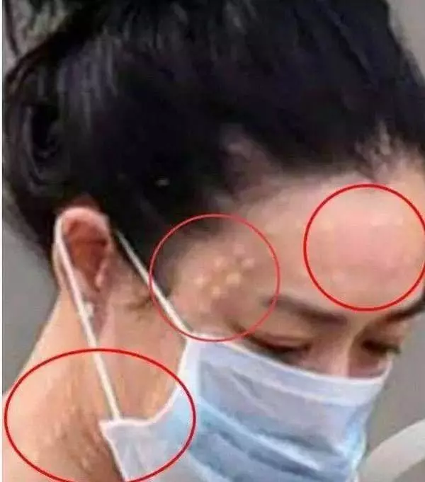 鐘麗緹全素顏出現行街,臉上打針的痕跡太嚇人,網民:不得不佩張倫碩娶她還是很有勇氣!