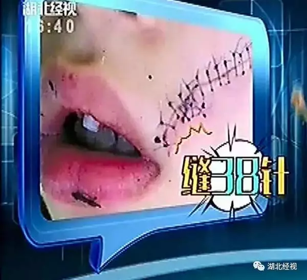 從冰箱拿出的可樂會有多危險?有孩子縫了38針!實驗告訴你真相 !
