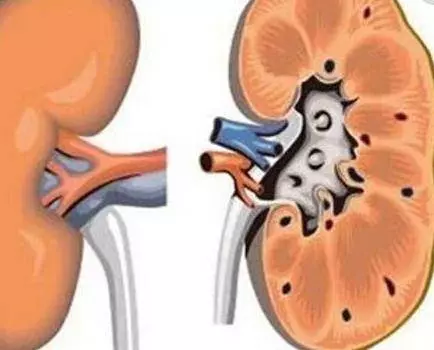 「腎」好不好看腳,如果腳上沒有3個表現,恭喜你,說明你的腎很健康