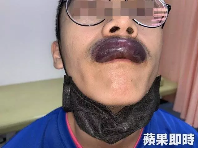 男子打籃球被撞 , 上唇變紫色香腸嘴 !