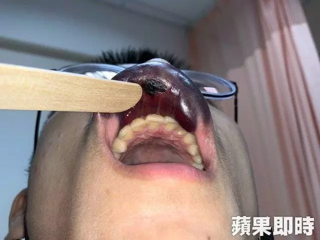 男子打籃球被撞 , 上唇變紫色香腸嘴 !