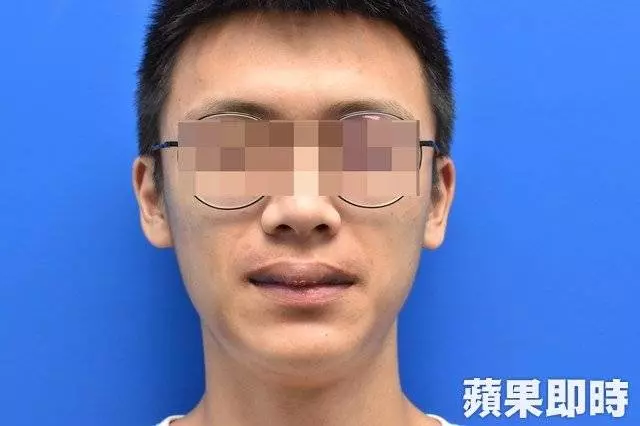 男子打籃球被撞 , 上唇變紫色香腸嘴 !