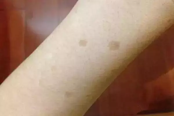 老年斑是衰老的象徵,出現了別擔心,2個小動作讓你告別老年斑重回年輕!