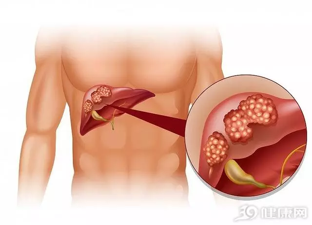 生存期僅4個月!肝癌晚期合併癌栓,他是如何治好的?