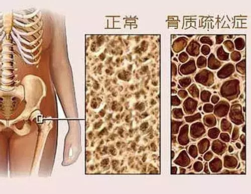 骨科大夫送您一份骨骼保養秘籍