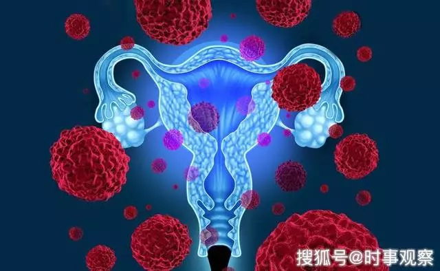 患上宮頸癌早知道:身體出現4個「異象」,女人要格外小心了 !