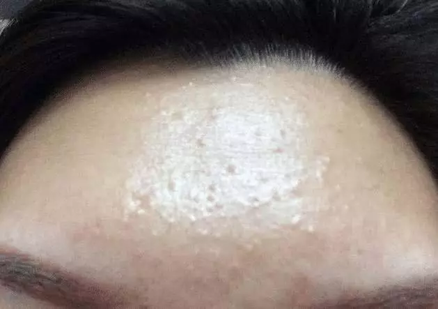 頭髮跟臉上經常出油,是怎麼回事?很有可能是脂溢性皮炎,要注意