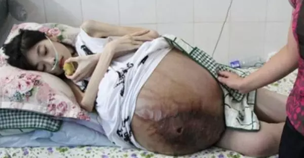 驚悚!24歲正妹「懷孕整整4年」,每個醫生看到她就搖頭,最後發現她肚子裡懷的竟是...太恐怖啦!!