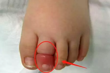 2歲兒子腳進「蟲」嚇壞寶媽,醫生看了說:再晚來一會就要截肢了