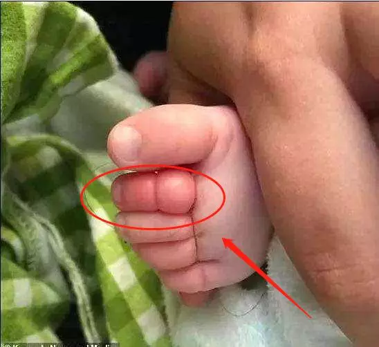 2歲兒子腳進「蟲」嚇壞寶媽,醫生看了說:再晚來一會就要截肢了