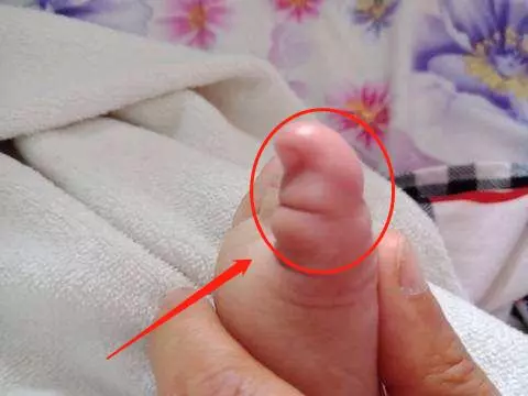 2歲兒子腳進「蟲」嚇壞寶媽,醫生看了說:再晚來一會就要截肢了