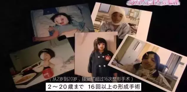 日本面部缺陷的無臉妹,被嘲笑為「怪物」,卻依然活得堅定溫柔!