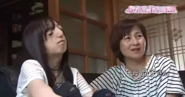日本面部缺陷的無臉妹,被嘲笑為「怪物」,卻依然活得堅定溫柔!