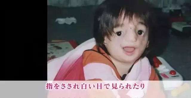 日本面部缺陷的無臉妹,被嘲笑為「怪物」,卻依然活得堅定溫柔!