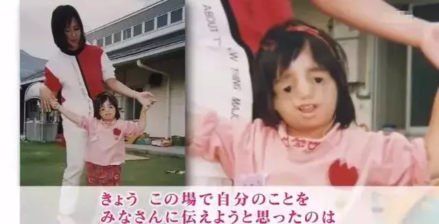 日本面部缺陷的無臉妹,被嘲笑為「怪物」,卻依然活得堅定溫柔!