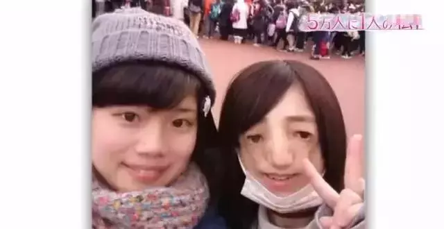 日本面部缺陷的無臉妹,被嘲笑為「怪物」,卻依然活得堅定溫柔!